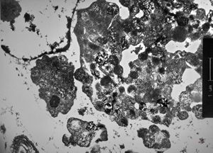 F,54y. | giant complex melanosomes … melanotic carcinosarcoma - uterus F,54y. | giant complex melanosomes … melanotic carcinosarcoma - uterus